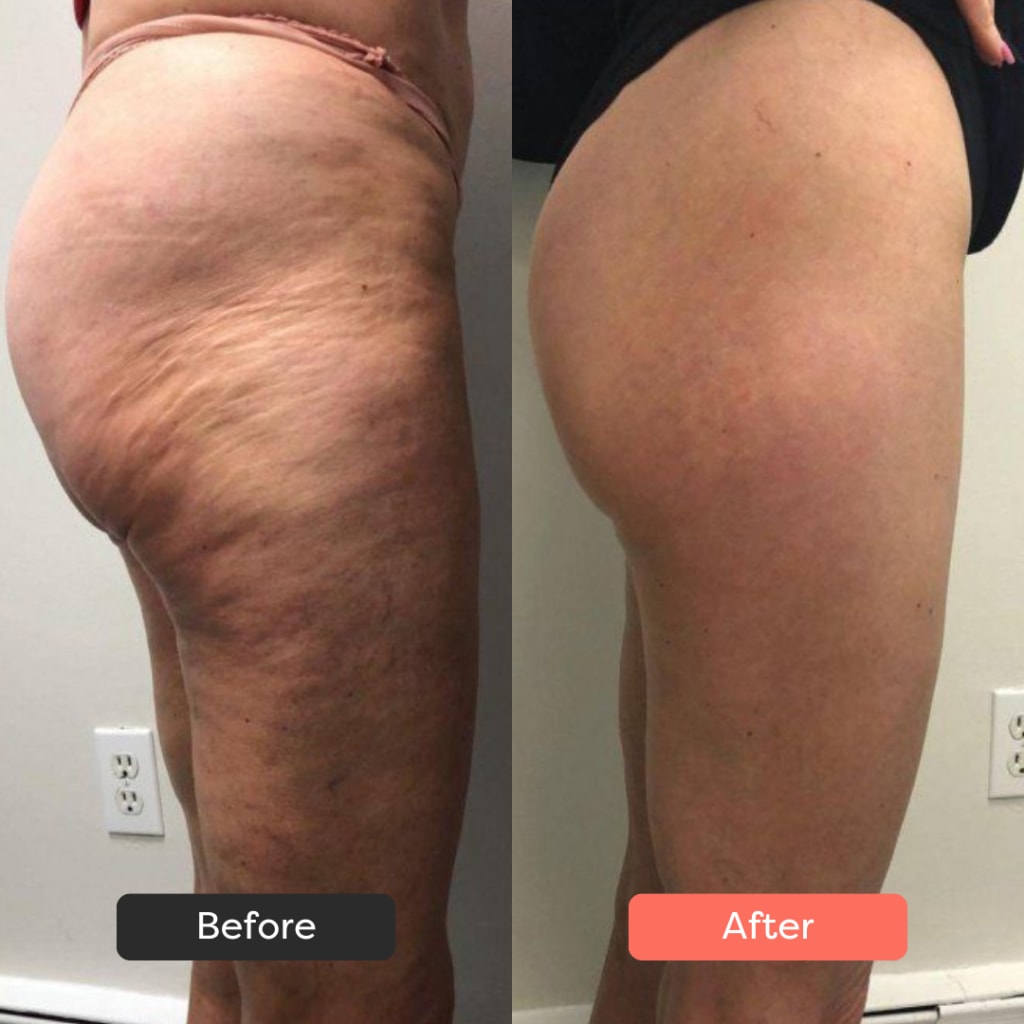 SolaraSculpt Body Sculpting Device