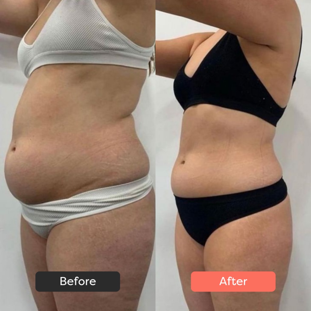 SolaraSculpt Body Sculpting Device