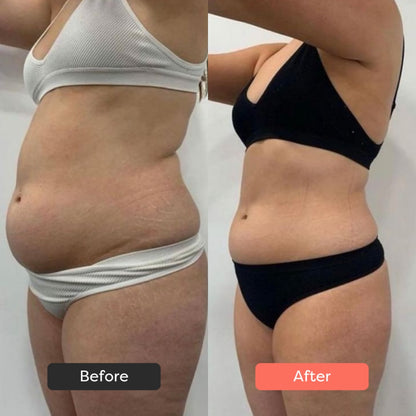SolaraSculpt Body Sculpting Device