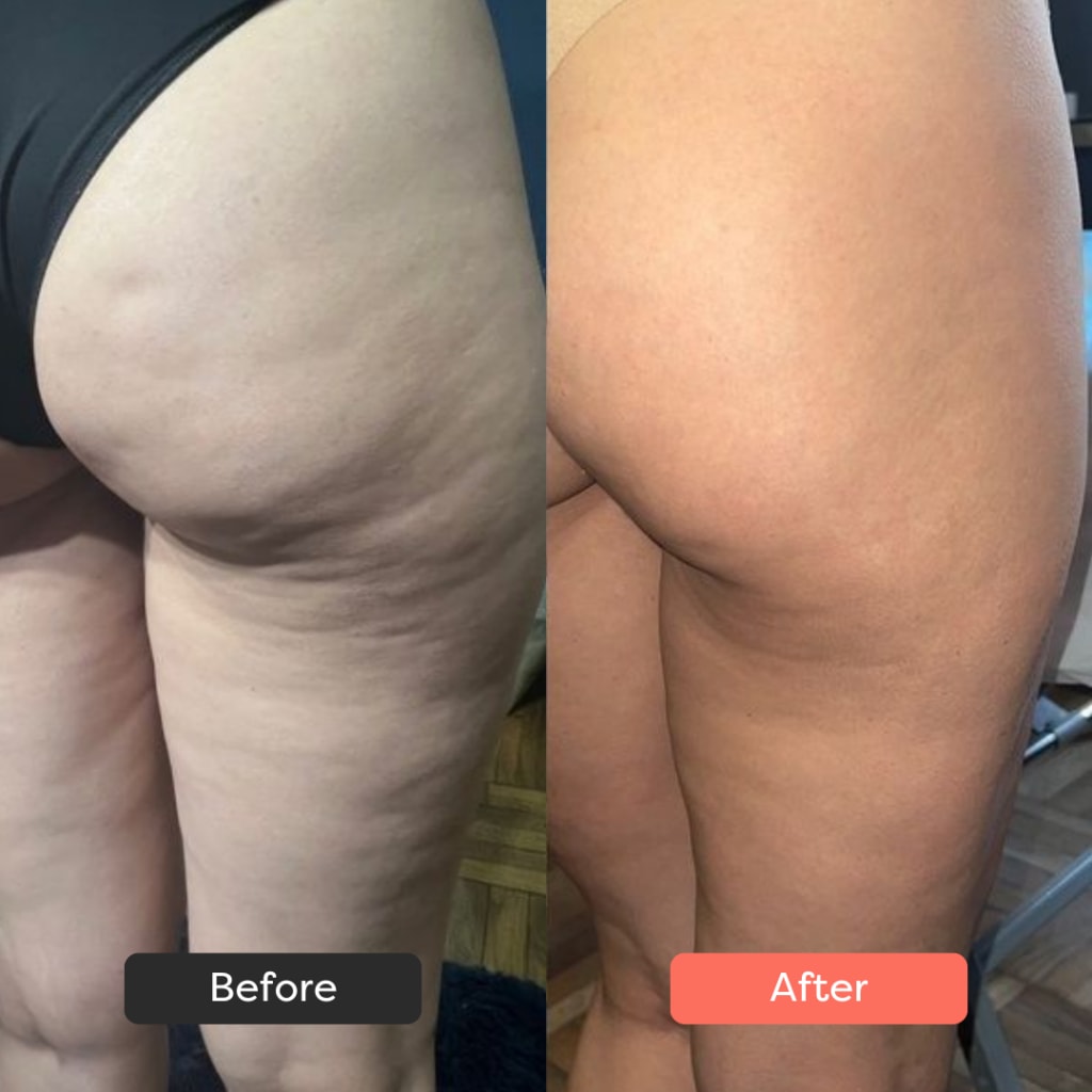 SolaraSculpt Body Sculpting Device